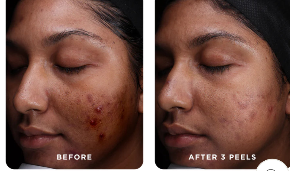 VI peel purify with precision + peptides Kit *new packaging*