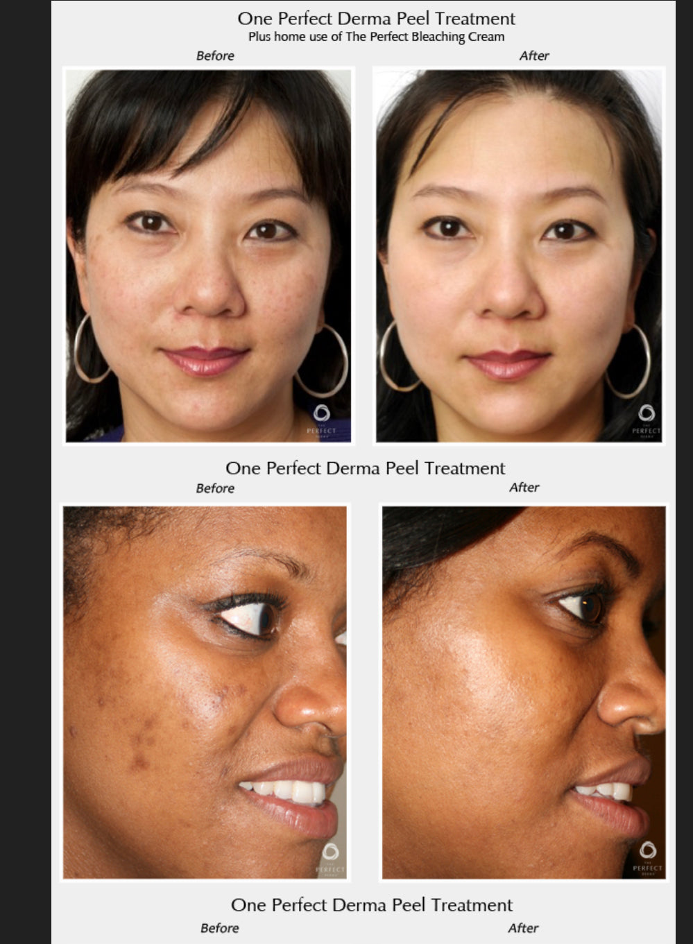 Buy Online Premium Quality The Perfect B Cream Hydroquinone Cream for Melasma | Shop for the Best Anti-aging Skincare Products - Ara by Ageless