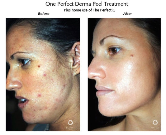 What is a Chemical Peel