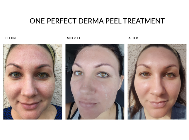 Bella medical peel with clear booster