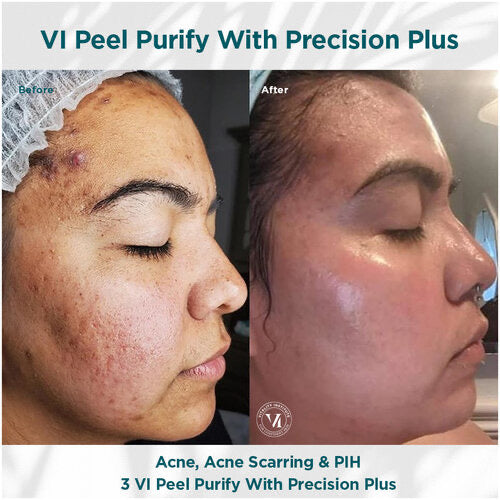 VI peel purify with precision + peptides Kit *new packaging*