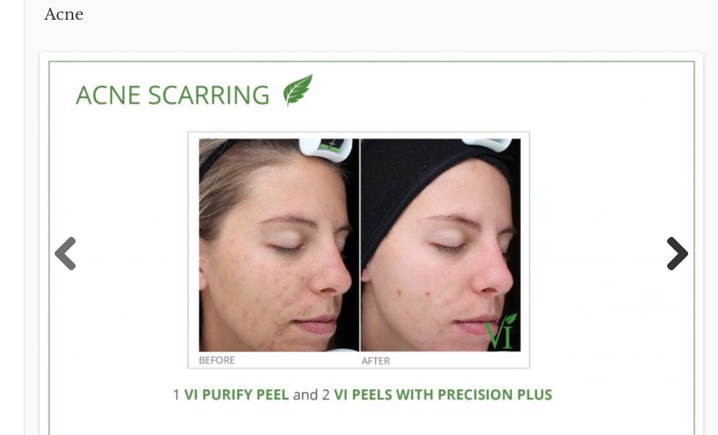 VI peel purify plus precision Kit *new packaging*