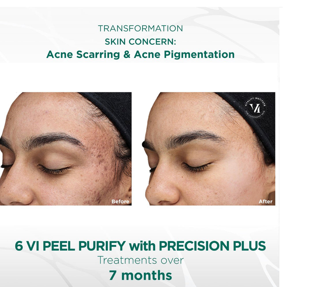 VI peel purify plus precision Kit *new packaging*