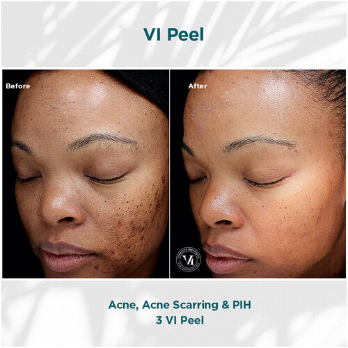 Buy Online Premium Quality VI Peel Original Kit | Shop for the Best Anti-aging Skincare Products - Ara by Ageless