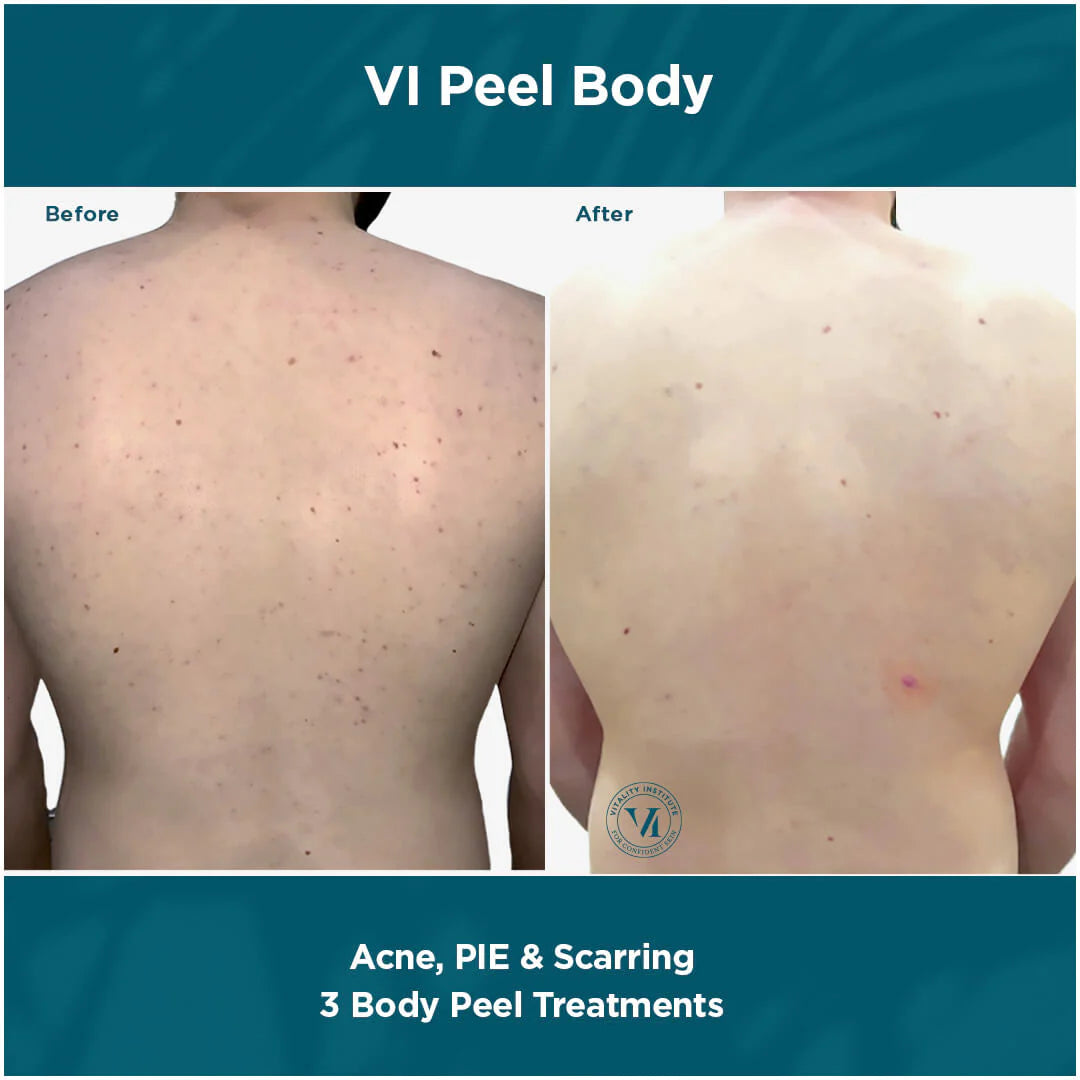 Buy Online Premium Quality VI PEEL BODY KIT | Shop for the Best Anti-aging Skincare Products - Ara by Ageless